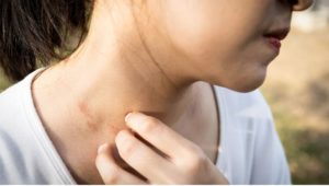 Palpebral étude clinique dermatite atopique