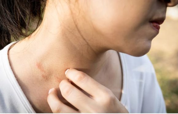 Palpebral étude clinique dermatite atopique